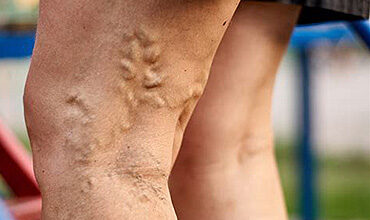 NON SURGICAL VARICOSE VEINS REMOVAL
