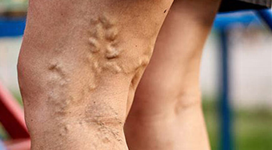 NON SURGICAL VARICOSE VEINS REMOVAL